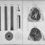 Black and white illustration of Laennec's stethoscope.